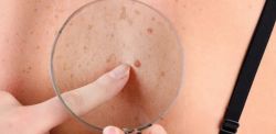 Cáncer de piel: desarrollan la primera vacuna de ARNm